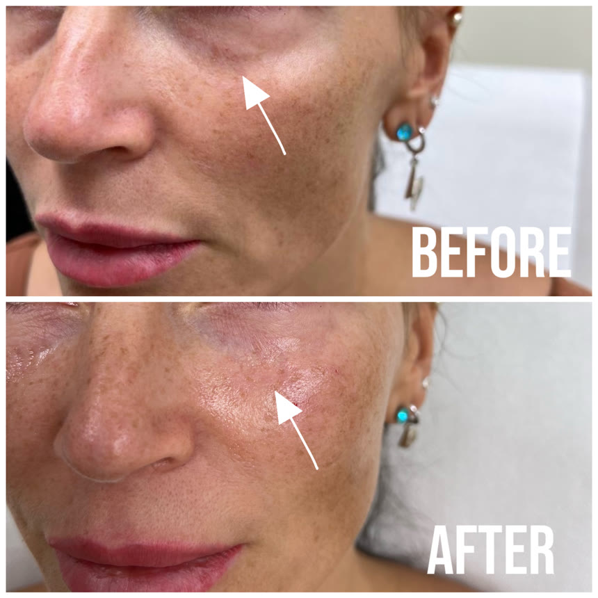 Facial filler before and after — Dr. Belove result