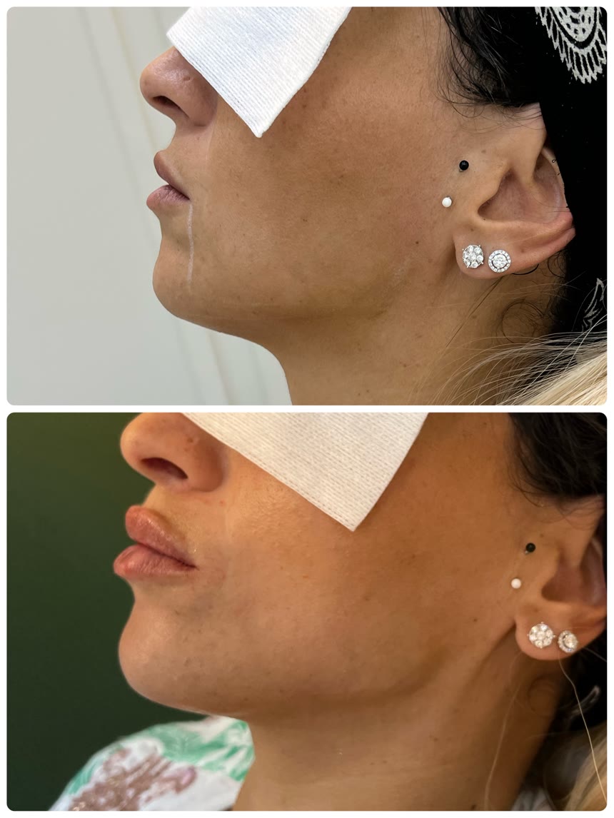 Chin filler before and after — Dr. Belove result