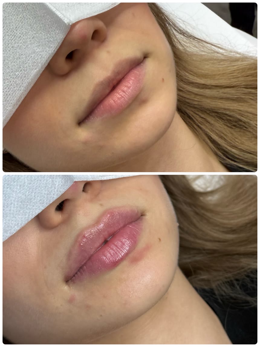 Lip filler before and after — Dr. Belove result