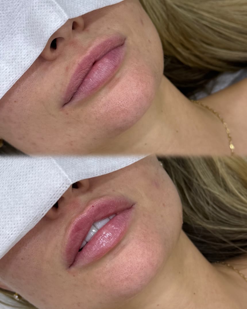 Lip filler before and after — Dr. Belove result