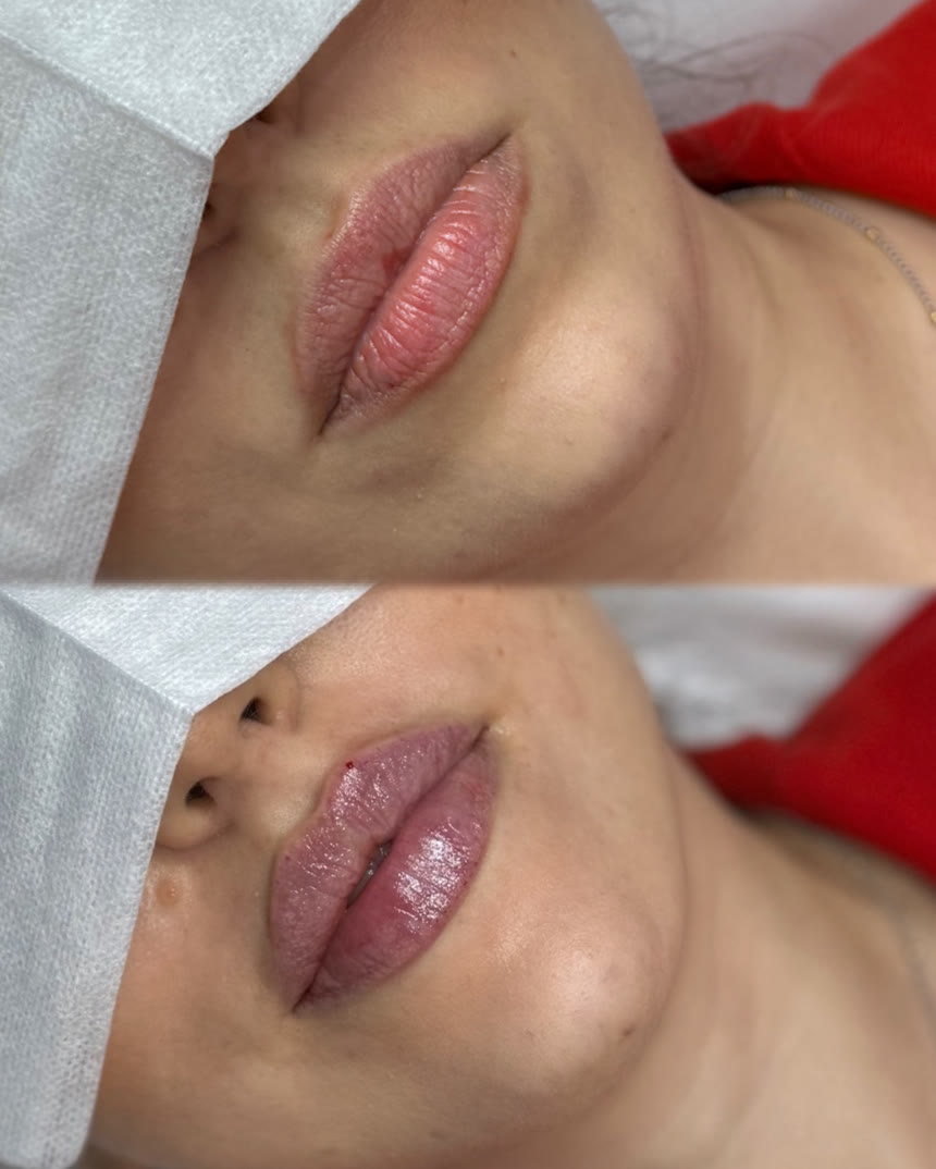 Lip filler before and after — Dr. Belove result
