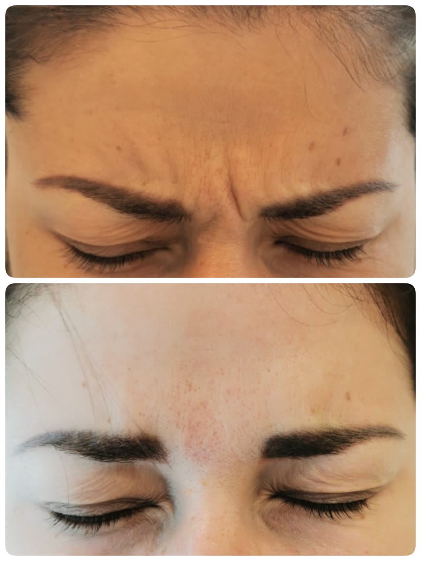Botox before and after — Dr. Belove result