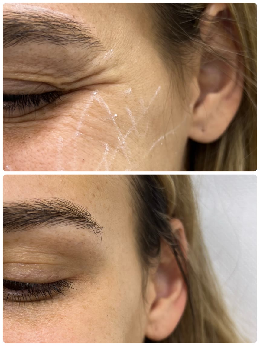 Botox before and after — Dr. Belove result